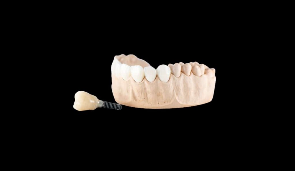 Dental implant